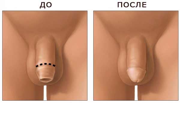 До и после операции обрезание крайней плоти у мужчин